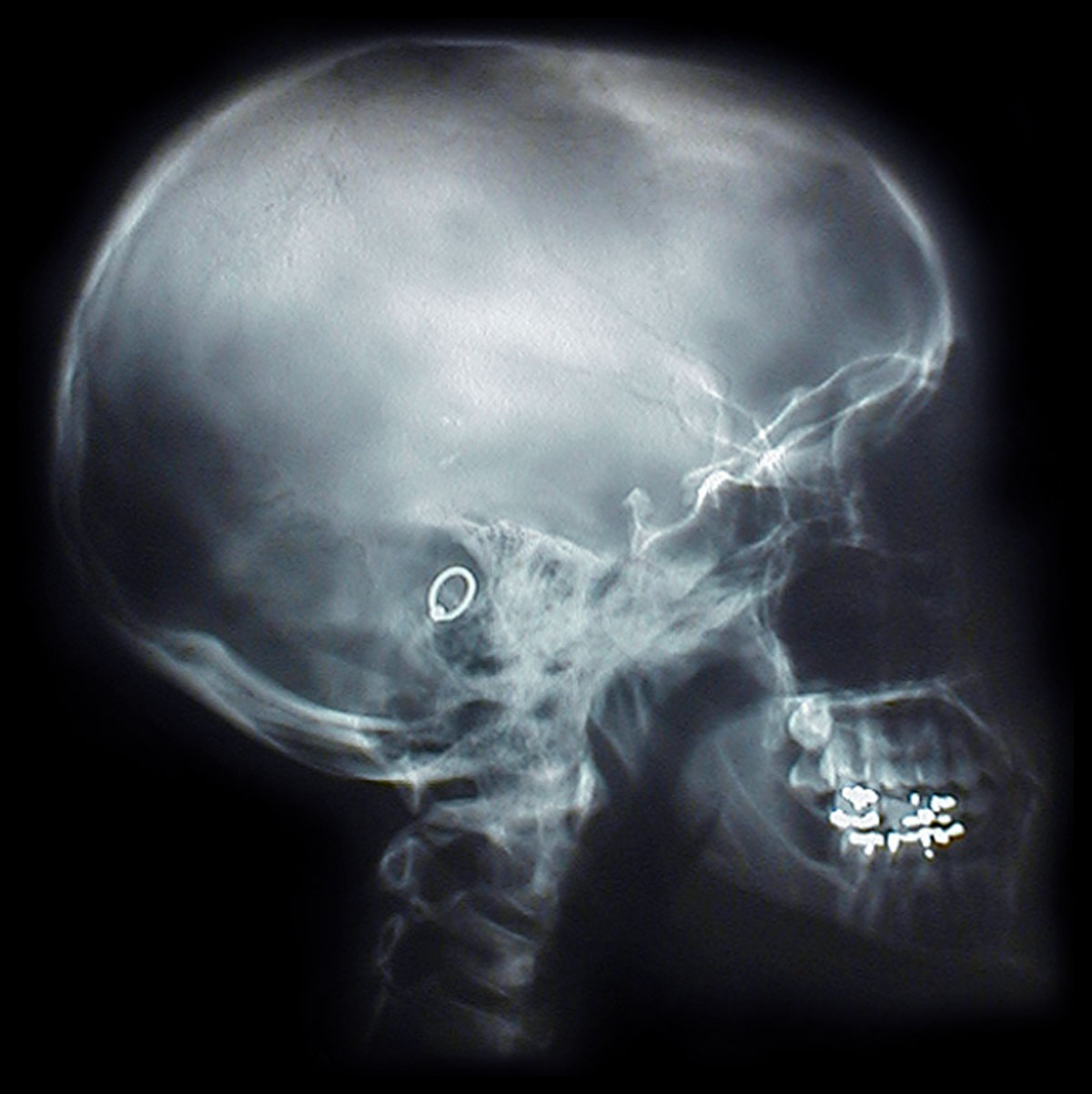 Medical Malp;ractice X-Ray misread